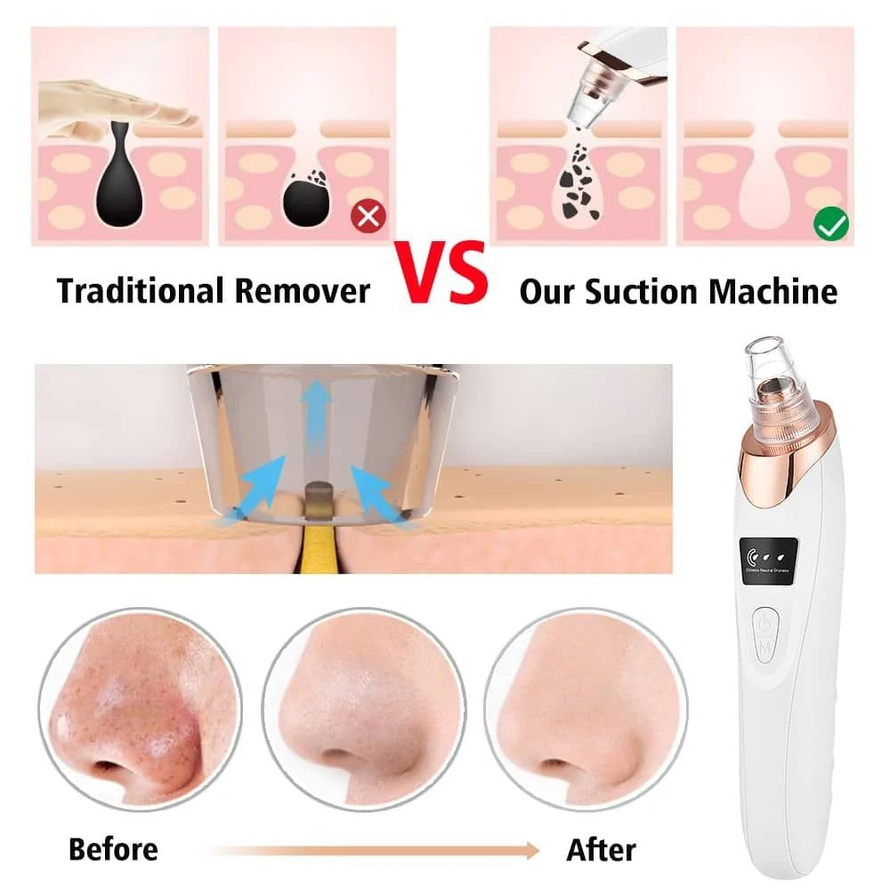 Digital Blackhead Remover – Electric Pore & Acne Cleaner